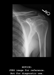 TJ's shoulder x-ray Clavicle and Scapula 1st degree separation